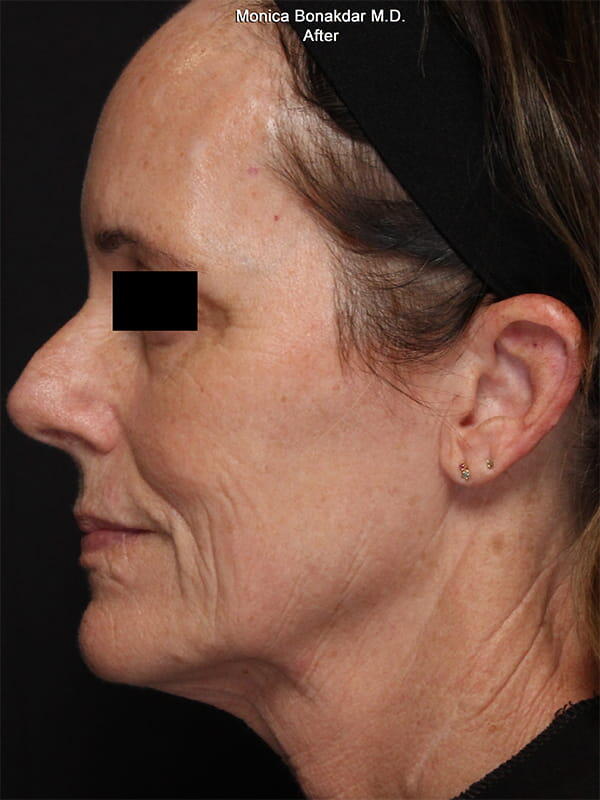 CoolPeel Before & After Photo