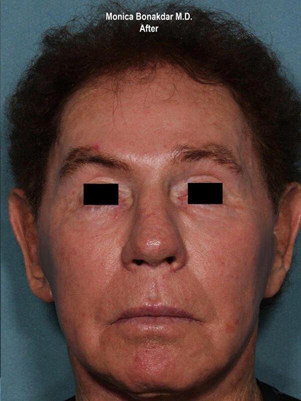 Vascular Laser Before & After Photo