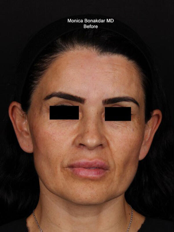 AmpliPHI Full Face Optimization - Women Before & After Photo